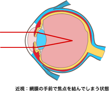 近視