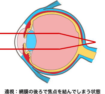 遠視