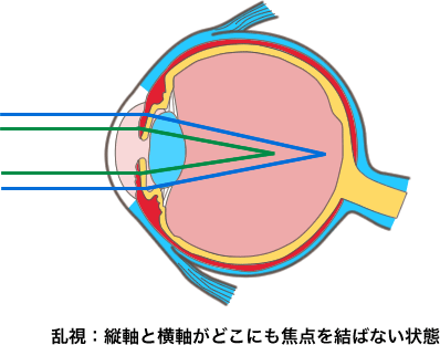 乱視